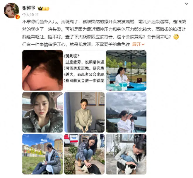 张馨予发文称压力大斑秃，沈梦辰也曾因斑秃上热搜，传说中的“鬼剃头”到底是怎么回事？
